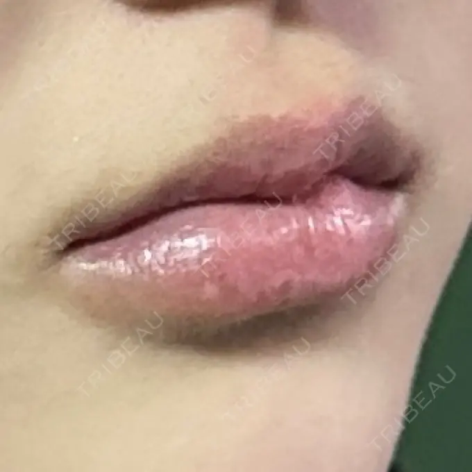 ヒアルロン酸注入（唇） / ボトックス（口角） ルラ美容クリニック 高田馬場院 DAY 72 メイン用