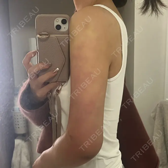 脂肪吸引（二の腕） / 脂肪吸引（肩） 4Dクリニック AFTER メイン用