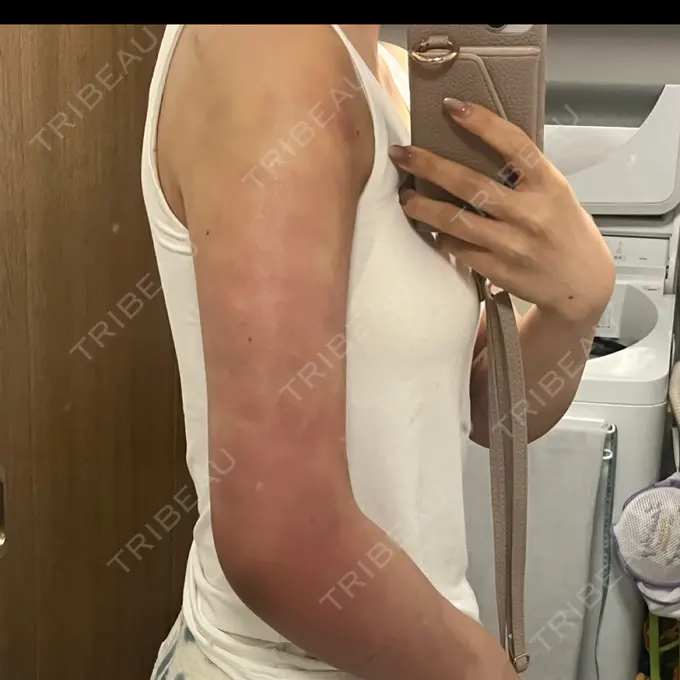 脂肪吸引（二の腕） / 脂肪吸引（肩） 4Dクリニック DAY 2 メイン用