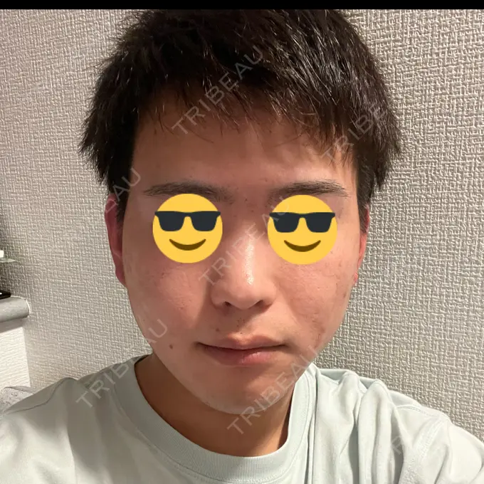 サブシジョン 藤・ナチュレ美容クリニック 銀座院 AFTER メイン用