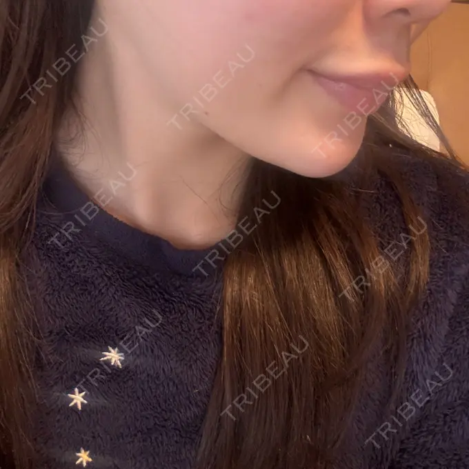 ヒアルロン酸注入（あご） KIMI CLINIC 形成・美容外科 AFTER メイン用