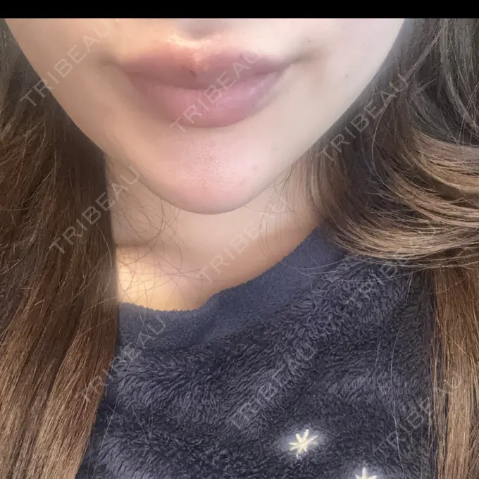 ヒアルロン酸注入（あご） KIMI CLINIC 形成・美容外科 DAY 1 メイン用