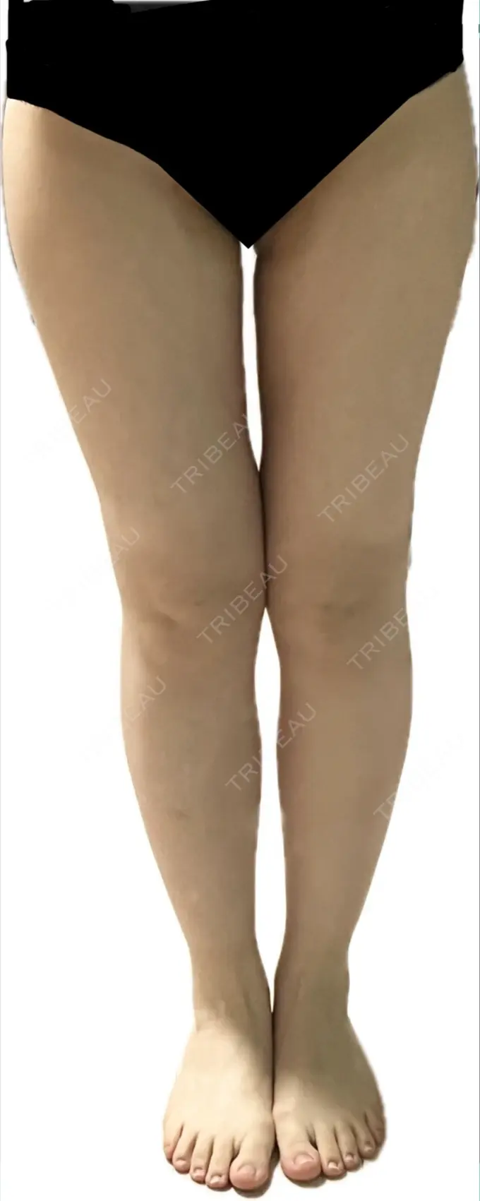 脂肪吸引（脚） Mods Clinic（モッズクリニック） 名古屋院 DAY 178 メイン用