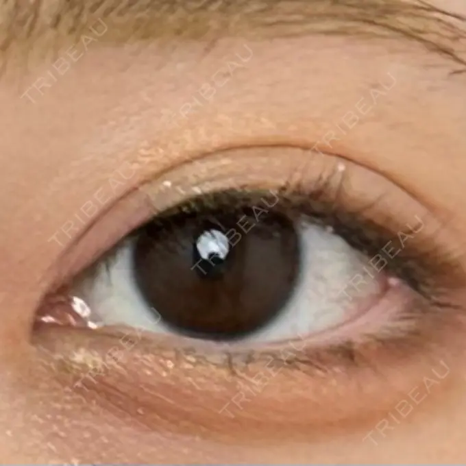 二重埋没 仙台N美容クリニック DAY 43 メイン用