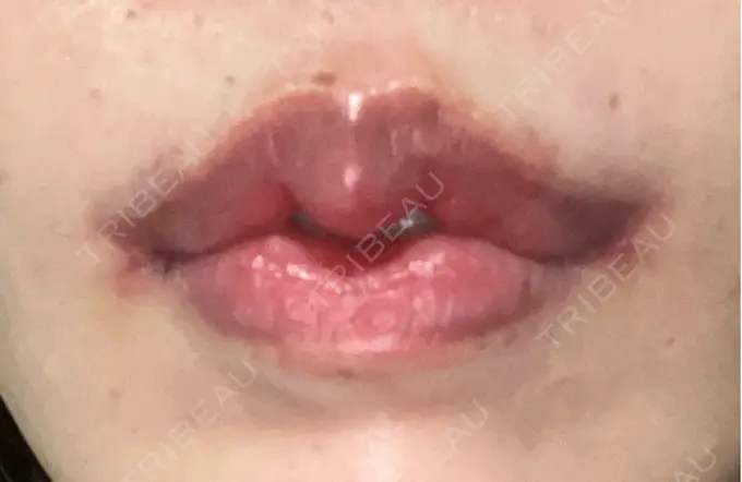 人中短縮 / 口角挙上 / その他（口元） R Beauty CLINIC 銀座院 DAY 44 メイン用