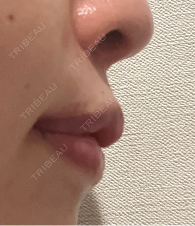 人中短縮 / 口角挙上 / その他（口元） R Beauty CLINIC 銀座院 DAY 44 メイン用