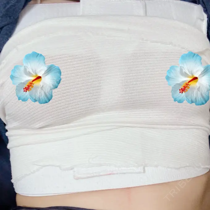 豊胸（シリコンバッグ） ジョウクリニック 那覇院 AFTER メイン用