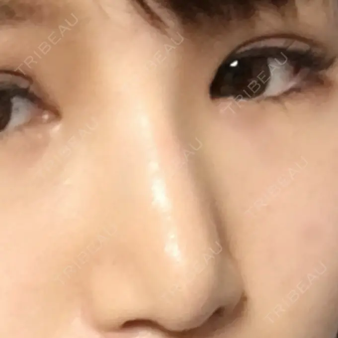 レディエッセ注入（鼻） 赤坂プレミアクリニック DAY 1 メイン用