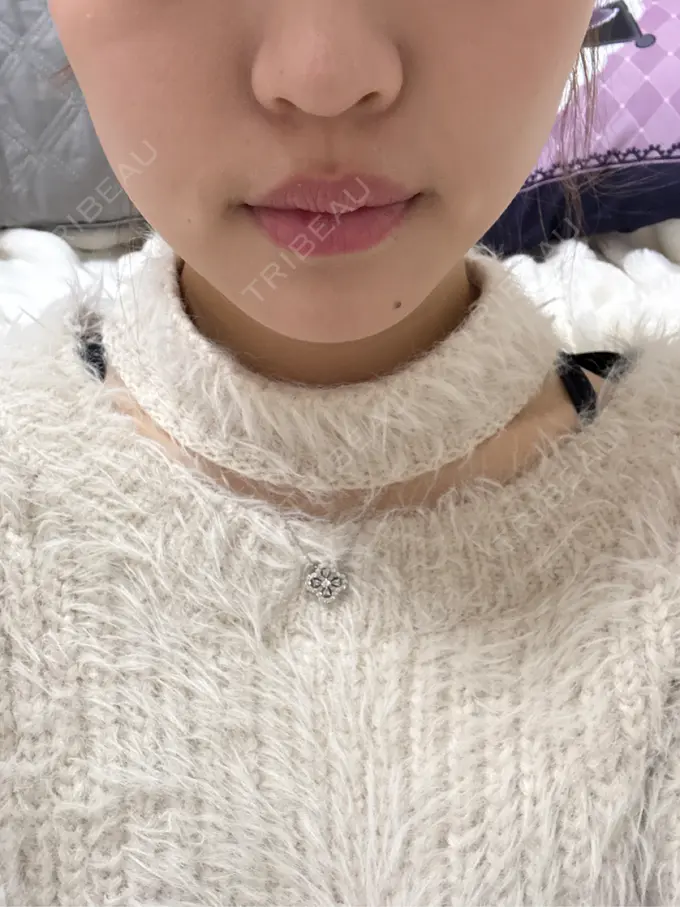 ボトックス（エラ・小顔） / その他（輪郭） ルラ美容クリニック 名古屋栄院 / ルラスキンクリニック 名古屋栄院 DAY 0 メイン用