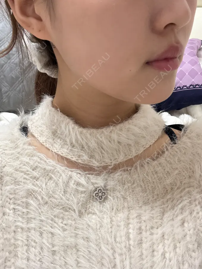 ボトックス（エラ・小顔） / その他（輪郭） ルラ美容クリニック 名古屋栄院 / ルラスキンクリニック 名古屋栄院 DAY 0 メイン用