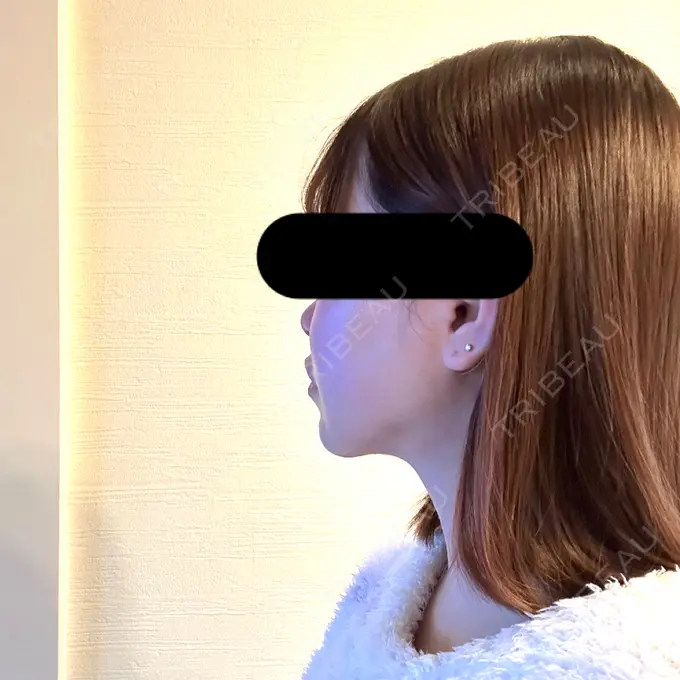 脂肪吸引（顔） / 脂肪吸引注射（顔） SEA CLINIC（シークリニック） AFTER メイン用