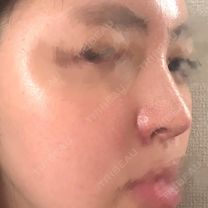 隆鼻術 / 鼻尖形成（切開） / 鼻中隔延長（切開） / 軟骨移植 / 鼻孔縁挙上 / 鼻孔縁下降 / 鼻翼基部形成（貴族手術） / その他（鼻） Designo Clinic （デジーノクリニック） DAY 21 メイン用