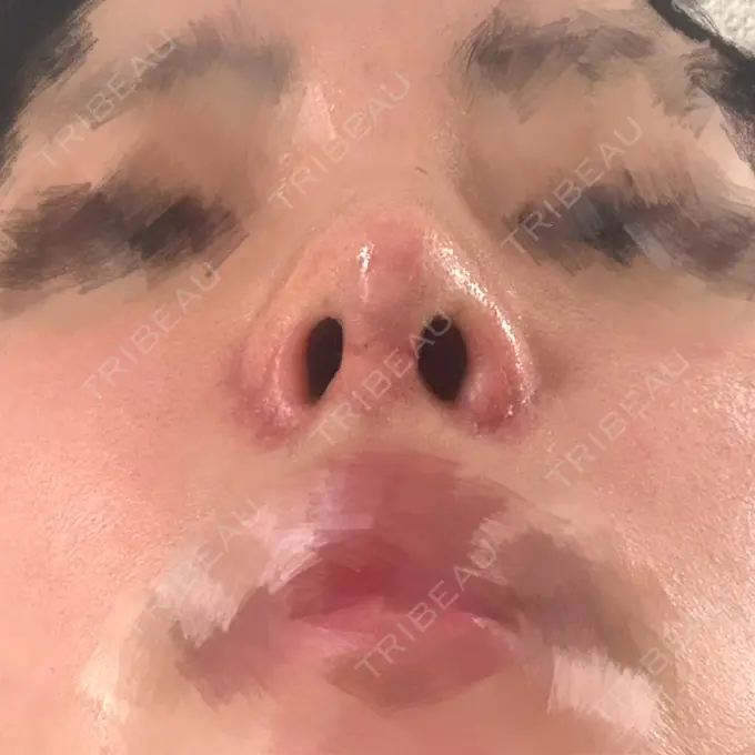 隆鼻術 / 鼻尖形成（切開） / 鼻中隔延長（切開） / 軟骨移植 / 鼻孔縁挙上 / 鼻孔縁下降 / 鼻翼基部形成（貴族手術） / その他（鼻） Designo Clinic （デジーノクリニック） DAY 21 メイン用