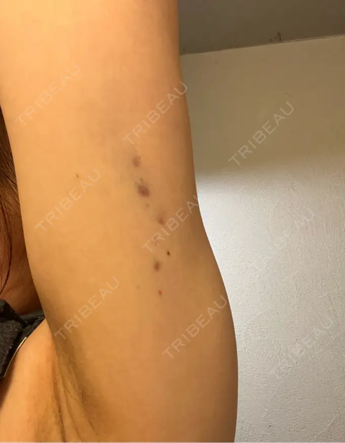 脂肪溶解注射（二の腕） MKクリニック 日本橋院 DAY 1 メイン用