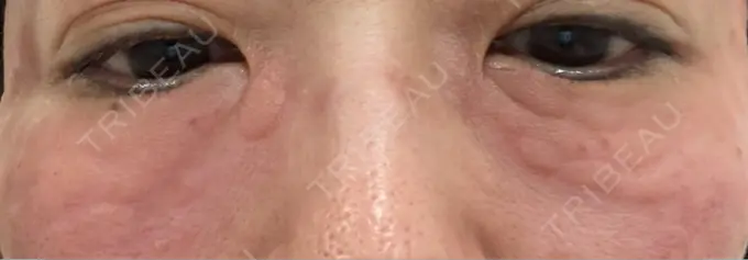 クマ治療 / 美容点滴・美容注射（疲労回復） REVO CLINIC PLUS DAY 0 メイン用