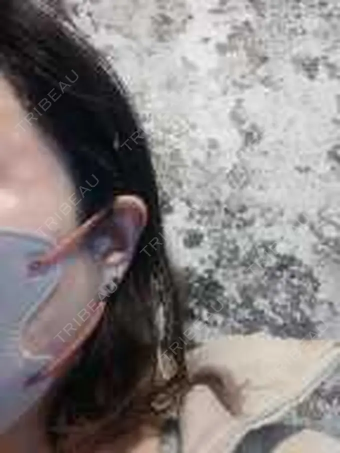 ピアス穴あけ 新宿ラクル美容外科クリニック 六本木院 AFTER メイン用