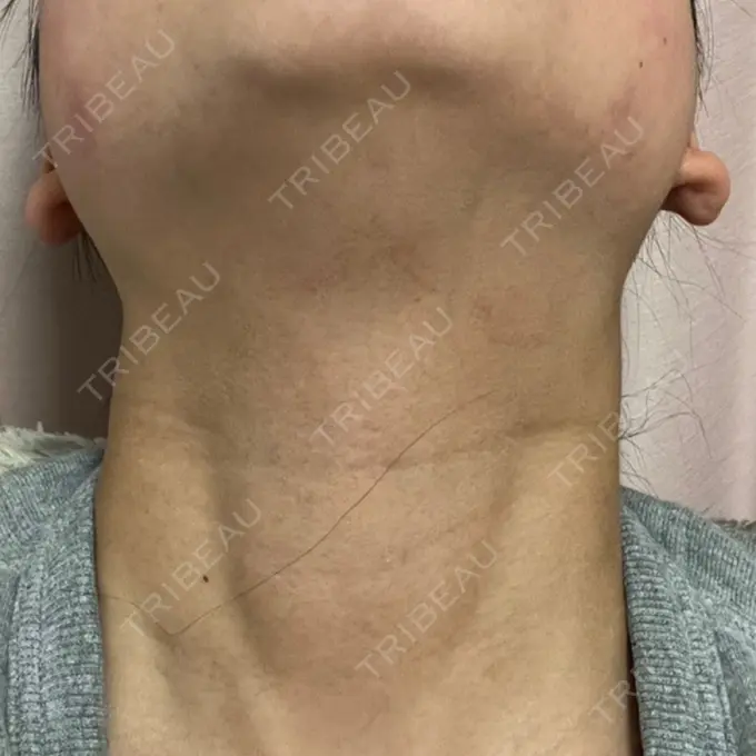 RF（高周波）たるみ治療 RIVER CLINIC（リバークリニック） DAY 0 メイン用