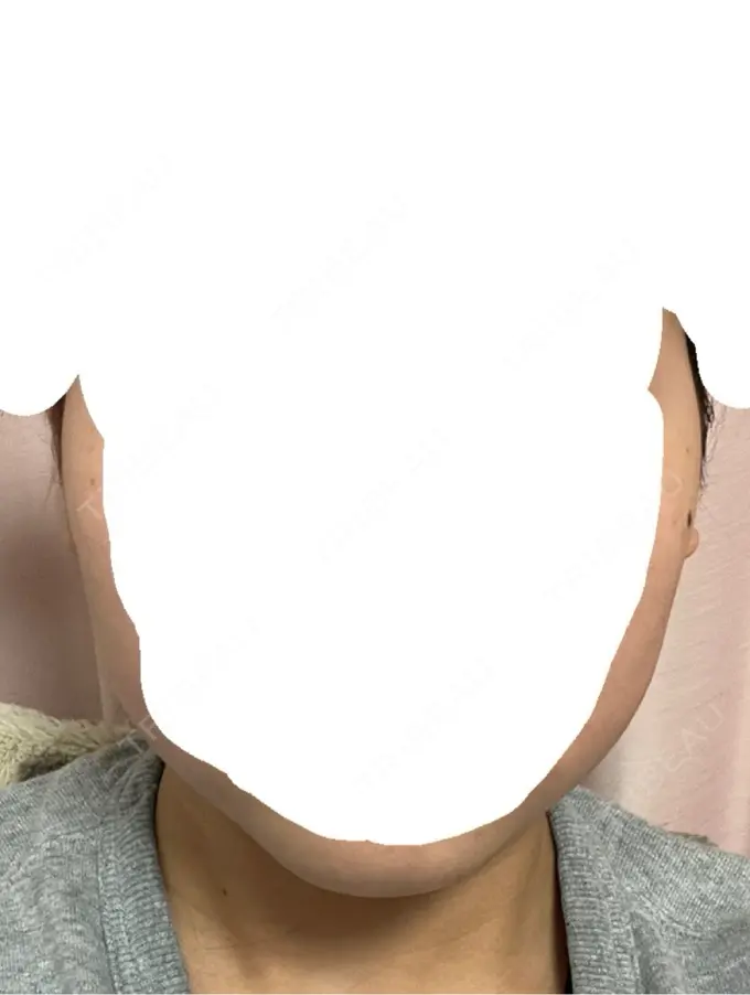 RF（高周波）たるみ治療 RIVER CLINIC（リバークリニック） DAY 0 メイン用