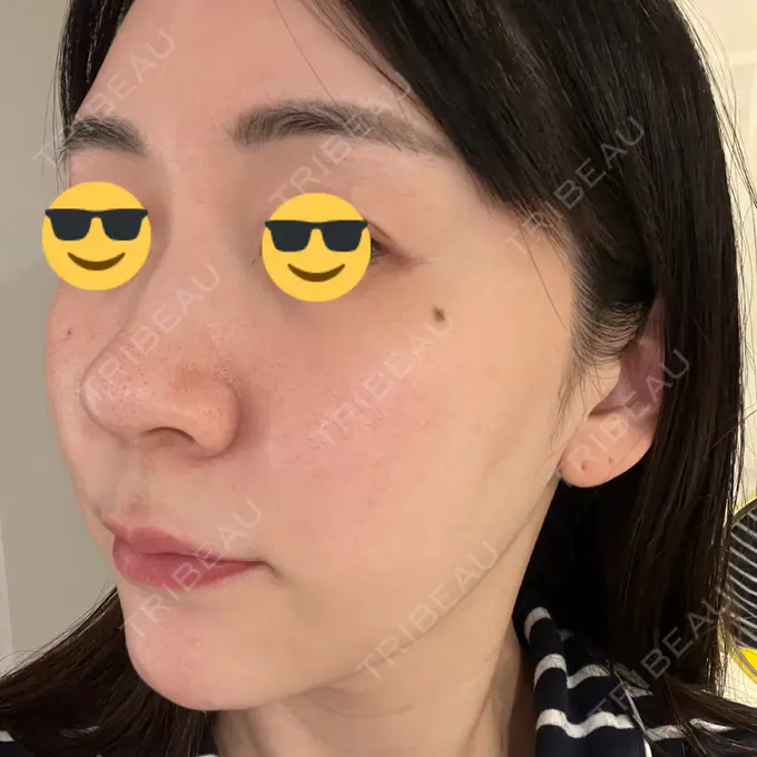 水光注射（ハリ・美肌） 韓国みにょんクリニック DAY 12 メイン用