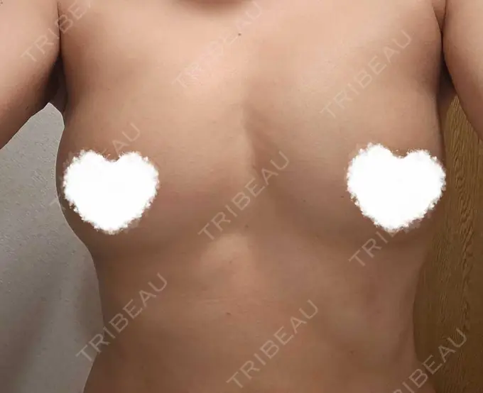 脂肪吸引（二の腕） / 豊胸（脂肪注入） / 脂肪吸引（肩） Mods Clinic（モッズクリニック） 名古屋院 DAY 28 メイン用