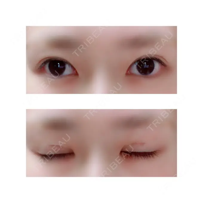 二重切開 有楽町高野美容クリニック DAY 37 メイン用