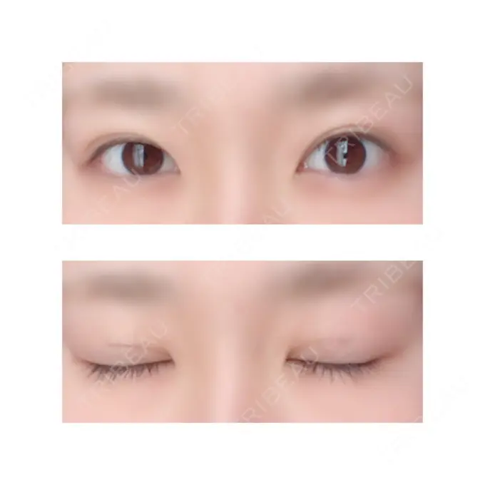 二重切開 有楽町高野美容クリニック DAY 43 メイン用