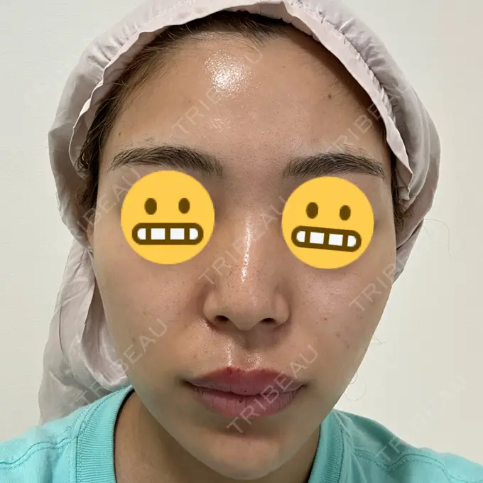 エレクトロポレーション / 毛穴洗浄（ハイドラフェイシャルなど） 心斎橋KT美容クリニック DAY 0 メイン用