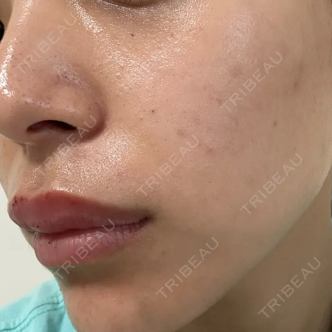 エレクトロポレーション / 毛穴洗浄（ハイドラフェイシャルなど） 心斎橋KT美容クリニック DAY 0 メイン用