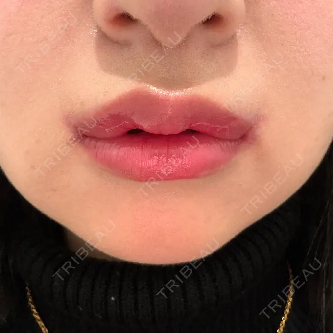 人中短縮 / 口角挙上 / その他（口元） R Beauty CLINIC 銀座院 AFTER メイン用