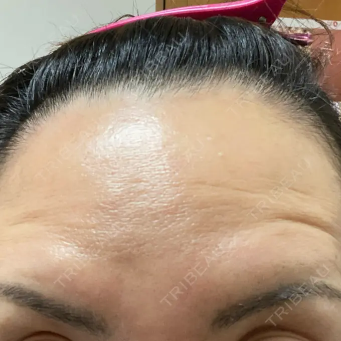 ボトックス（額） TCB東京中央美容外科 神戸院 DAY 8 メイン用