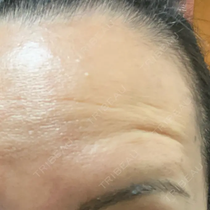 ボトックス（額） TCB東京中央美容外科 神戸院 DAY 9 メイン用