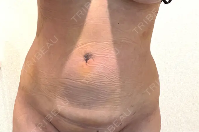 脂肪吸引（お腹） / 脂肪吸引（腰） オアシス美容外科 DAY 7 メイン用