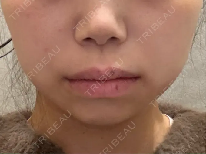 ハイフ（顔） GRACY TOKYO CLINIC【グレイシートウキョウクリニック】 DAY 0 メイン用