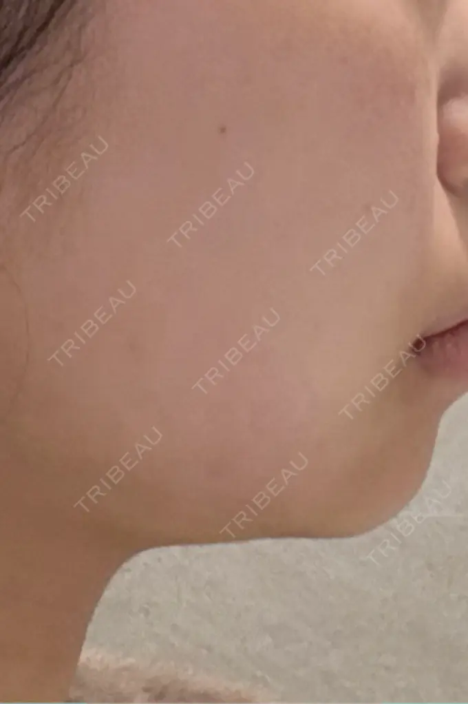 ハイフ（顔） GRACY TOKYO CLINIC【グレイシートウキョウクリニック】 DAY 0 メイン用