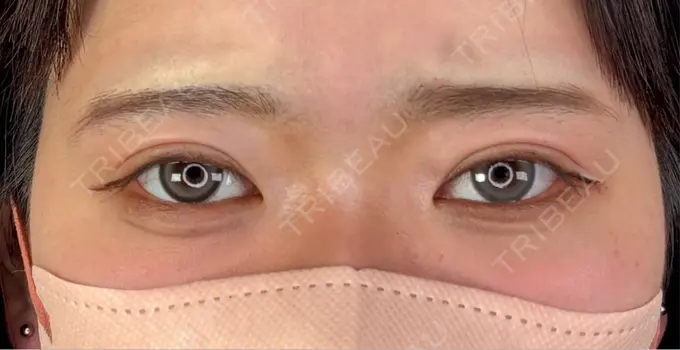 二重埋没 アリエル美容クリニック 郡山院 AFTER メイン用