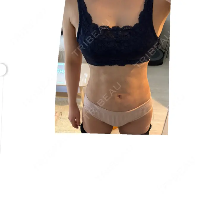 脂肪吸引（二の腕） / 脂肪吸引（腰） / 脂肪吸引（肩） / 医療脱毛（お腹） Mods Clinic（モッズクリニック） 大阪院 AFTER メイン用