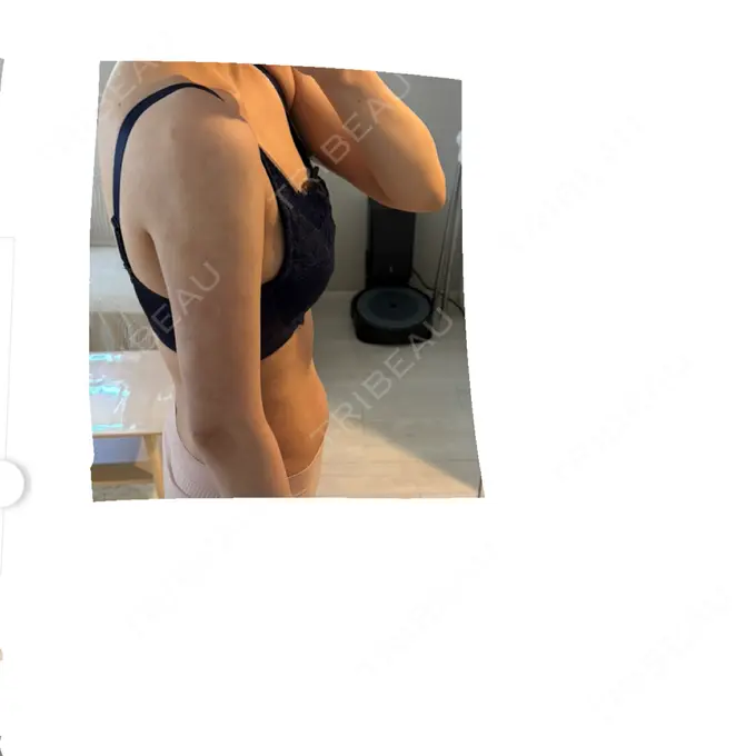 脂肪吸引（二の腕） / 脂肪吸引（腰） / 脂肪吸引（肩） / 医療脱毛（お腹） Mods Clinic（モッズクリニック） 大阪院 DAY 187 メイン用