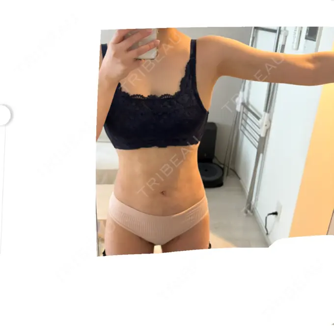 脂肪吸引（二の腕） / 脂肪吸引（腰） / 脂肪吸引（肩） / 医療脱毛（お腹） Mods Clinic（モッズクリニック） 大阪院 DAY 187 メイン用