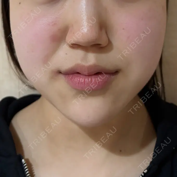 ボトックス（エラ・小顔） / ボトックス（肩） HAAB BEAUTY CLINIC 名古屋院 AFTER メイン用