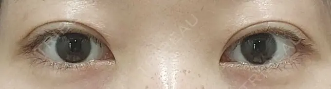 二重埋没 聖心美容クリニック 六本木院 DAY 3 メイン用