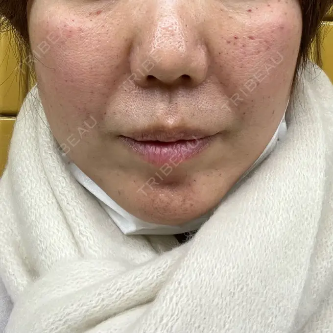 水光注射（ハリ・美肌） 筋肉・美容クリニック DAY 0 メイン用