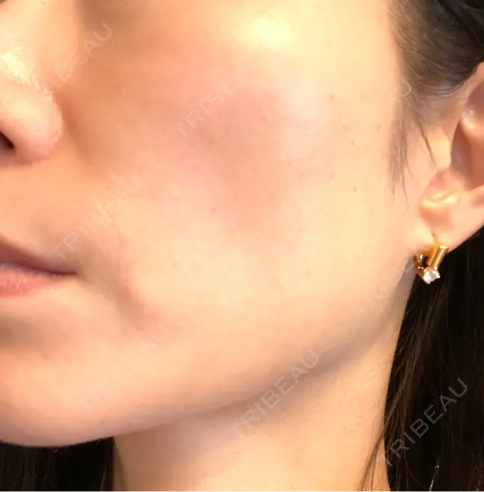 ボトックス（エラ・小顔） / ハイフ（顔） / ピーリング（ハリ・ツヤ） LOUIS CLINIC 二子玉川院【ルイクリニック】 AFTER メイン用