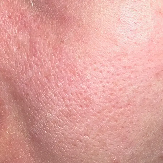 ポテンツァ REDLINE CLINIC AFTER メイン用