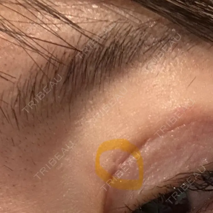 糸リフト / 脂肪吸引（顔） / 脂肪吸引（二の腕） / 上まぶたたるみ取り / 上まぶたの脂肪取り / ジョールファット除去 / 脂肪吸引（肩） / ボトックス（エラ・小顔） 湘南美容クリニック 秋葉原院 DAY 283 メイン用