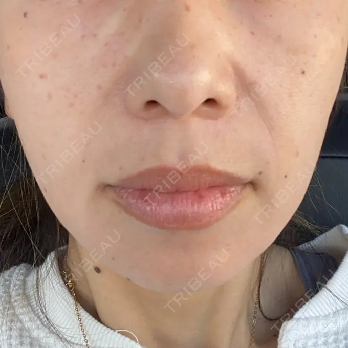 水光注射（ハリ・美肌） 筋肉・美容クリニック DAY 1 メイン用