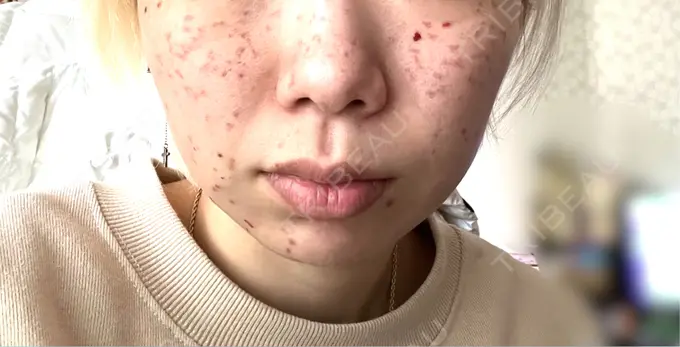 ピコスポット 東京シルククリニック 新宿院 DAY 3 メイン用