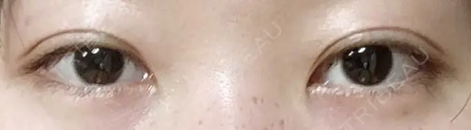 二重埋没 聖心美容クリニック 六本木院 DAY 4 メイン用