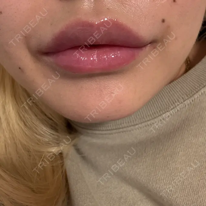 ボトックス（あご） / ヒアルロン酸注入（唇） / ボトックス（口角） eクリニック 那覇院 DAY 0 メイン用