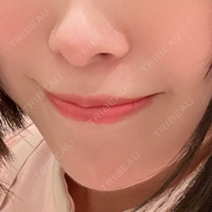 ヒアルロン酸注入（涙袋） / ボトックス（あご） / ボトックス（口角） フィラークリニック 大阪梅田院 AFTER メイン用