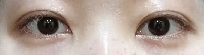 二重埋没 聖心美容クリニック 六本木院 DAY 5 メイン用